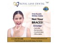 clear-aligners-in-dallas-small-1